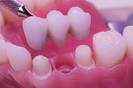 Under Which Conditions Is All On Four Implant Method Applied