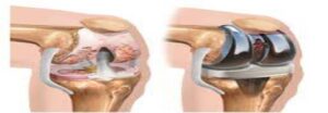 Germany Knee Replacement Best Prices